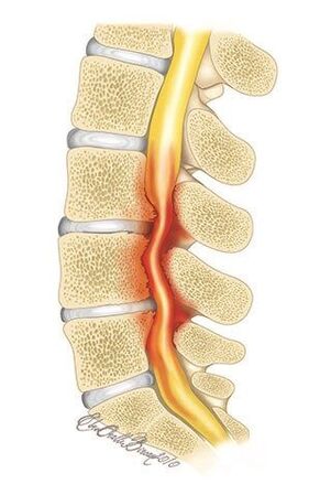 Sergant krūtinės ląstos stuburo osteochondroze, atsiranda stuburo kanalo suspaudimas