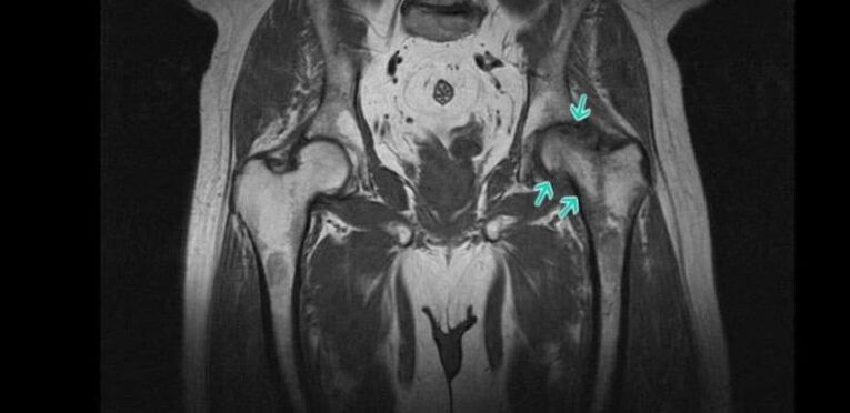 Klubo sąnario osteoartritas MRT